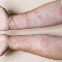 درمان حساسیت به چسب پانسمان