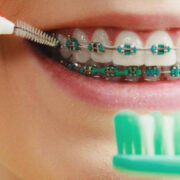 چگونگی مسواک زدن دندانهای ارتودنسی شده