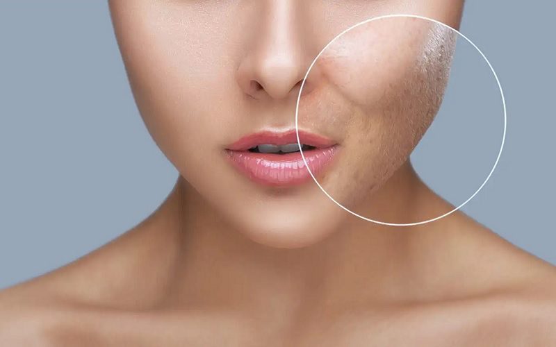 از بین بردن جای جوش