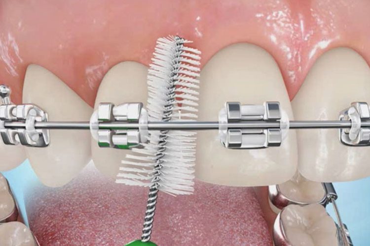 10 نکته برای پیشگیری از تحلیل لثه هنگام درمان ارتودنسی