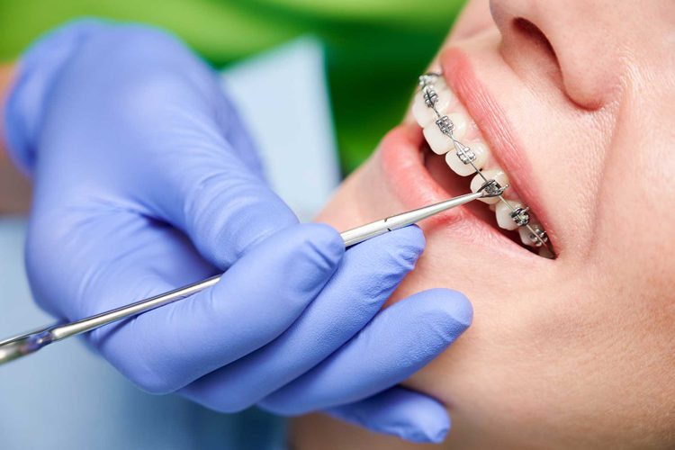 10 نکته برای پیشگیری از تحلیل لثه هنگام درمان ارتودنسی